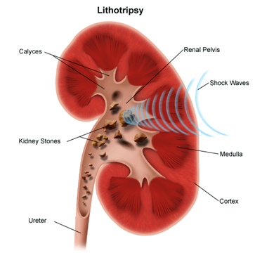 Kidney Treatment