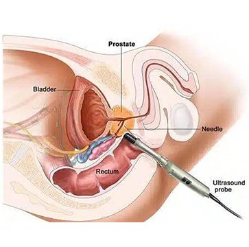 Open Prostate Surgery