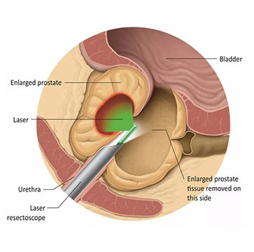 Prostate Laser Surgery
