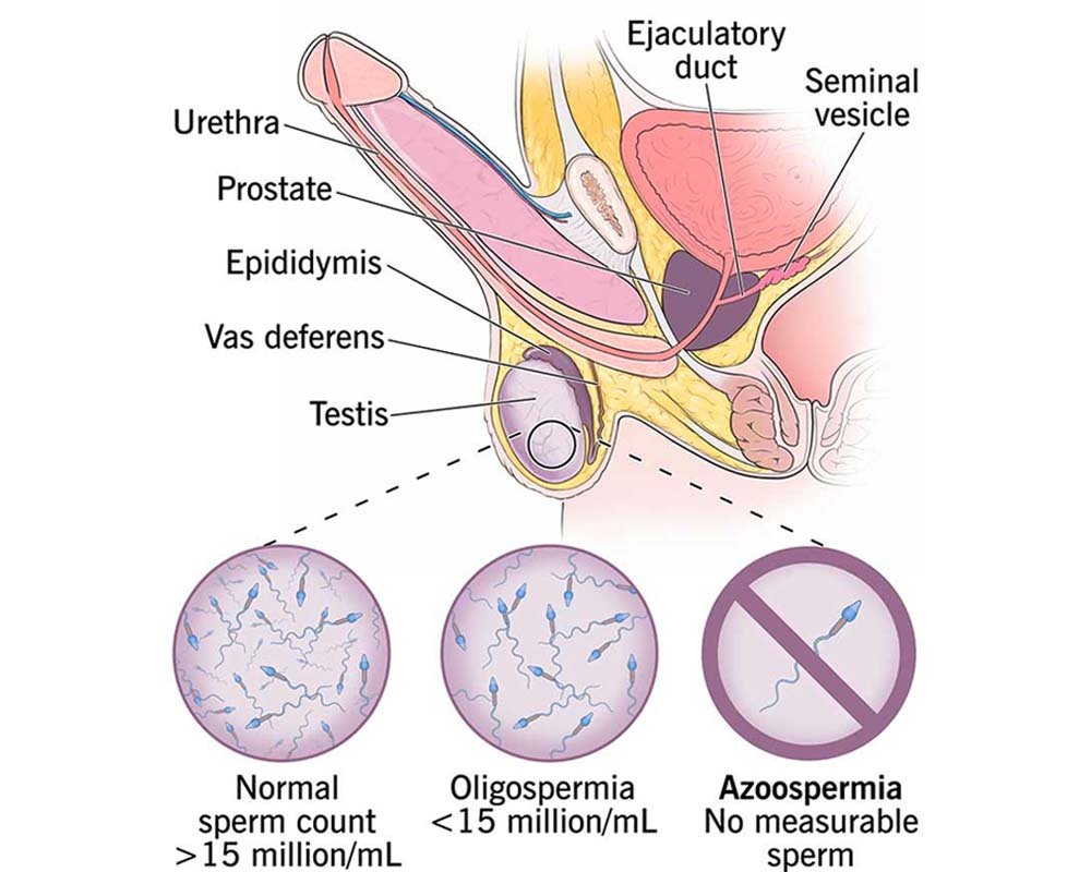 Azoospermia Treatment