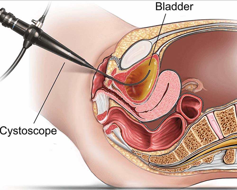 Cystoscopy Test